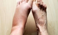   آرتروز مچ پا؛ از شناسایی دردهای خاموش تا راهکارهای پیشرفته جراحی